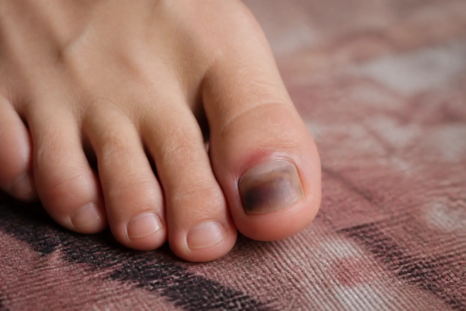 Orteil noir ongle après un choc, gros orteil avec hématome sous-unguéal, légère rougeur et gonflement au sol à la maison